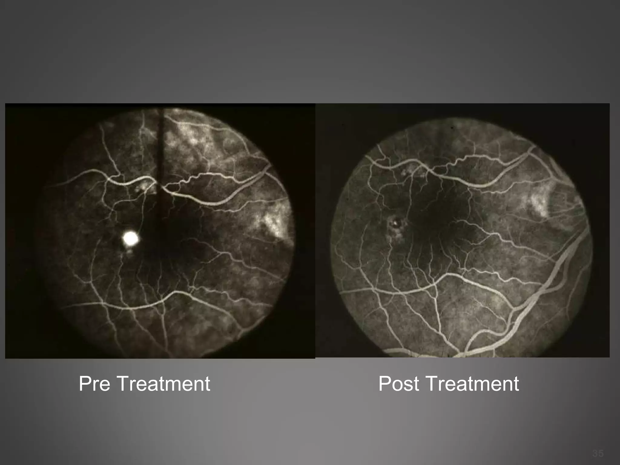 35
Pre Treatment Post Treatment
 