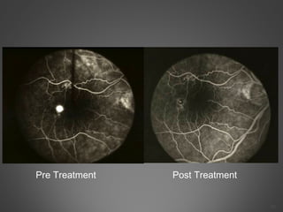 35
Pre Treatment Post Treatment
 