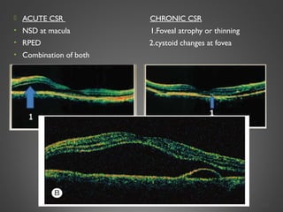 CENTRAL SEROUS CHORIOETINOPATHY | PPT
