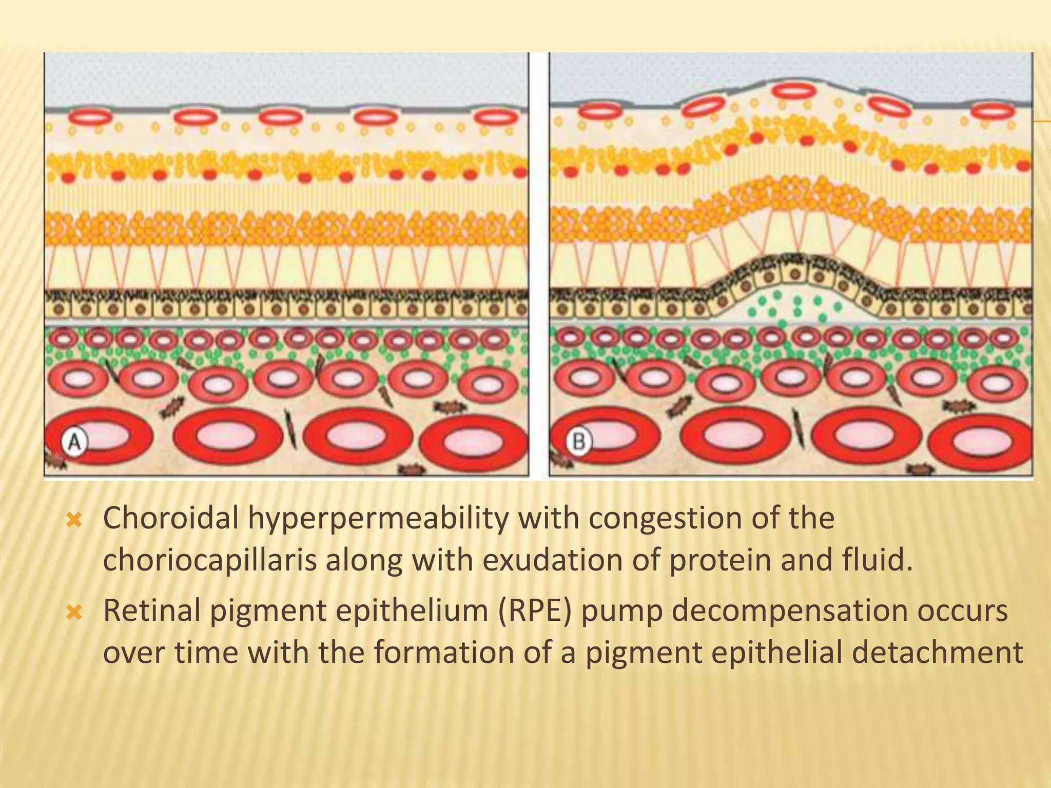 Central serous chorioretinopathy | PPTX