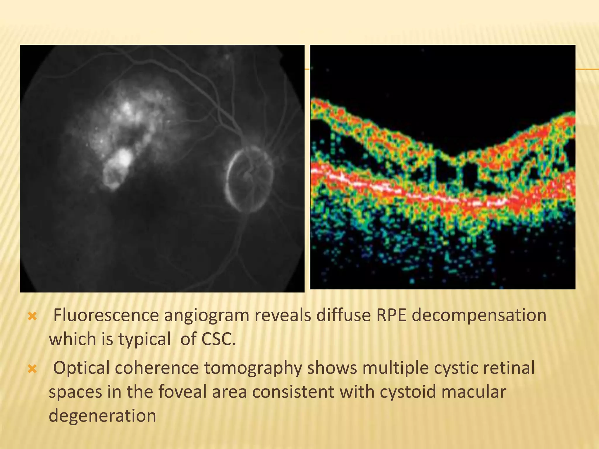 Central serous chorioretinopathy | PPTX