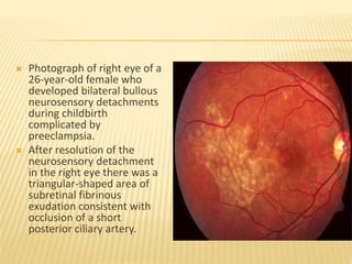 Central serous chorioretinopathy | PPTX