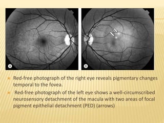Central serous chorioretinopathy | PPTX