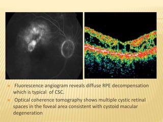 Csc Optical Lab Central serous chorioretinopathy | PPTX