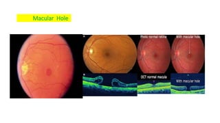 Cscr ( central serous chorioretinopathy ) | PPTX