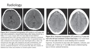 Chronic subdural hematoma brief for neurosurgery | PDF