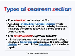 Cesarean Section - Procedure & Management - Dr Rohit Bhaskar | PDF