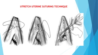 Utretch Inverting Suture Pattern C SECTION IN SMALL AND LARGE ANIMALSpptx | PPTX