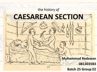 the history of
CAESAREAN SECTION
Muhammad Redzwan
081303583
Batch 25 Group E2
 