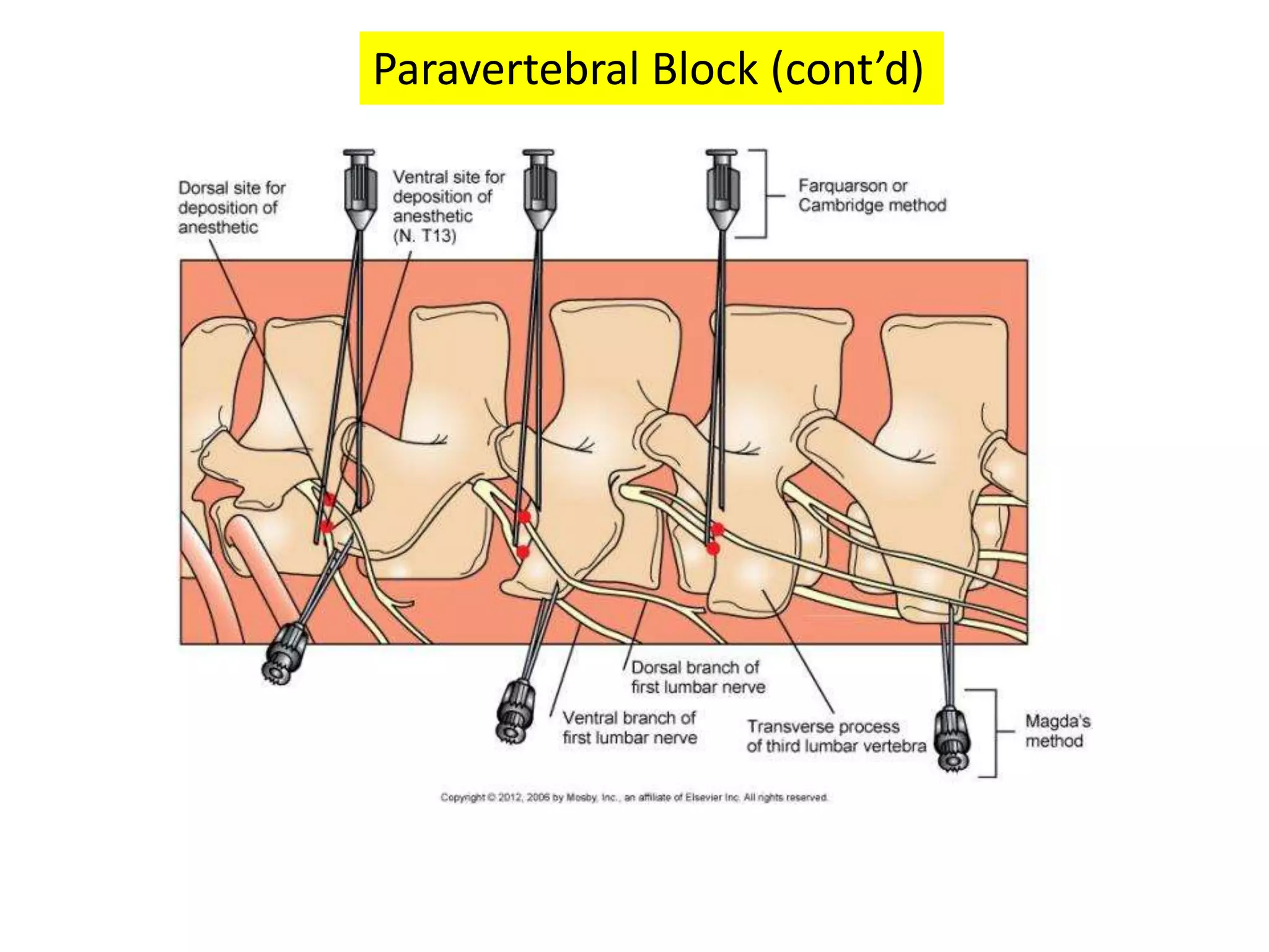 Paravertebral Block (cont’d)
 