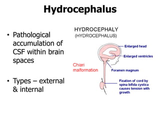 Hydrocephalus
• Pathological
accumulation of
CSF within brain
spaces
• Types – external
& internal
 