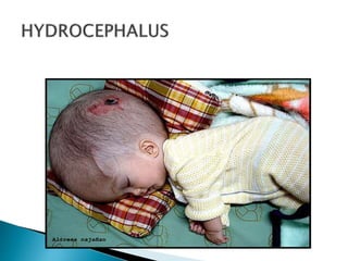 Csf(cerebro spinal fluid)