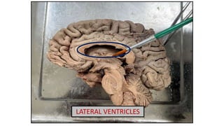 LATERAL VENTRICLES
 