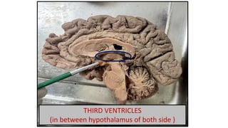 THIRD VENTRICLES
(in between hypothalamus of both side )
 
