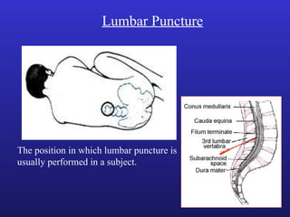 Lumbar Puncture
The position in which lumbar puncture is
usually performed in a subject.
 