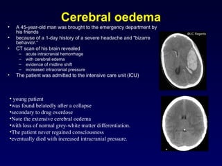 Comprehensive Overview of Cerebrospinal Fluid: Physiology, Function ...