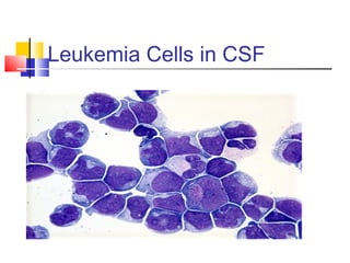 Leukemia Cells in CSF
 