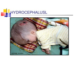 HYDROCEPHALUSL
 