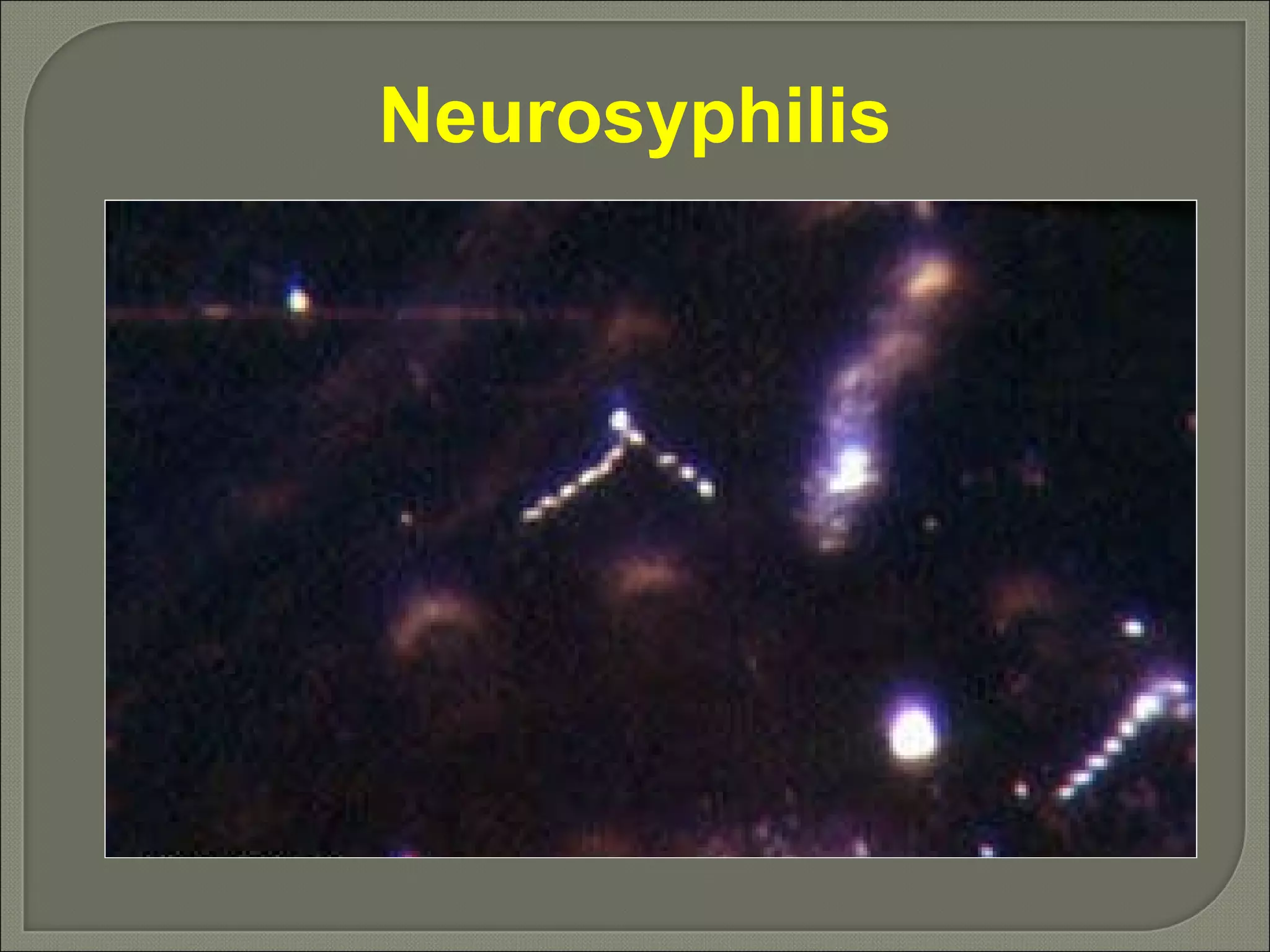 Neurosyphilis 