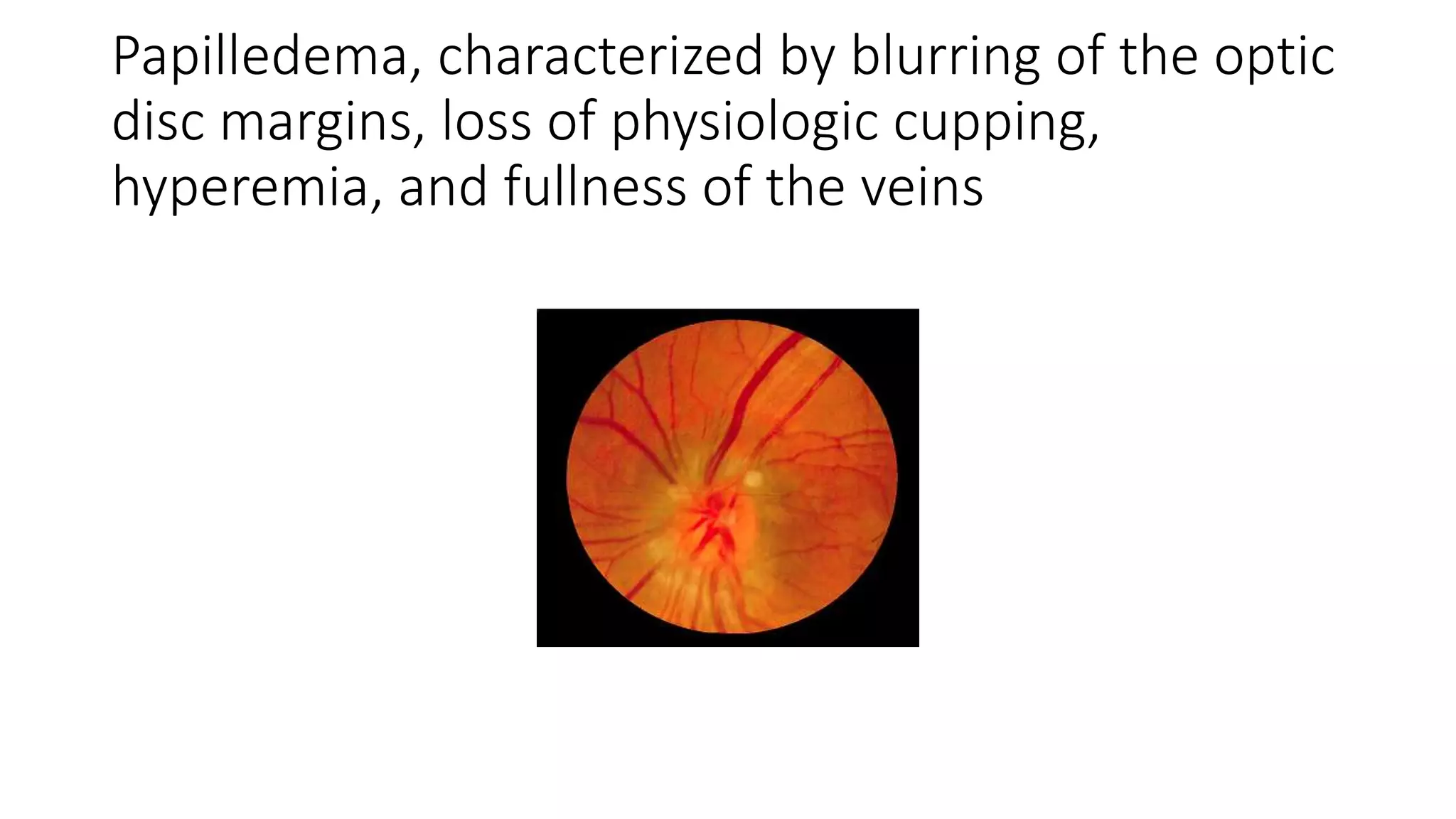 Papilledema, characterized by blurring of the optic
disc margins, loss of physiologic cupping,
hyperemia, and fullness of the veins
 