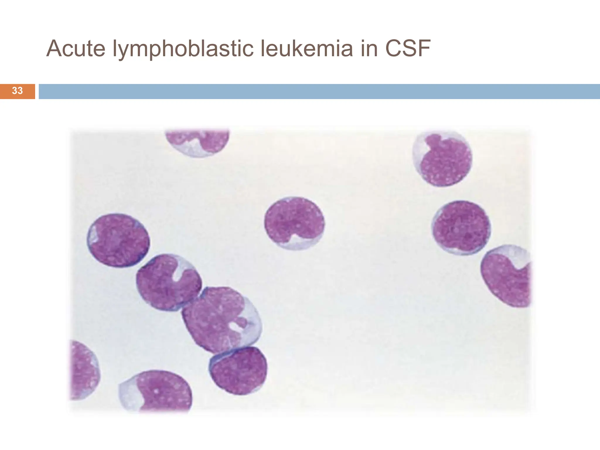 Acute lymphoblastic leukemia in CSF
33
 