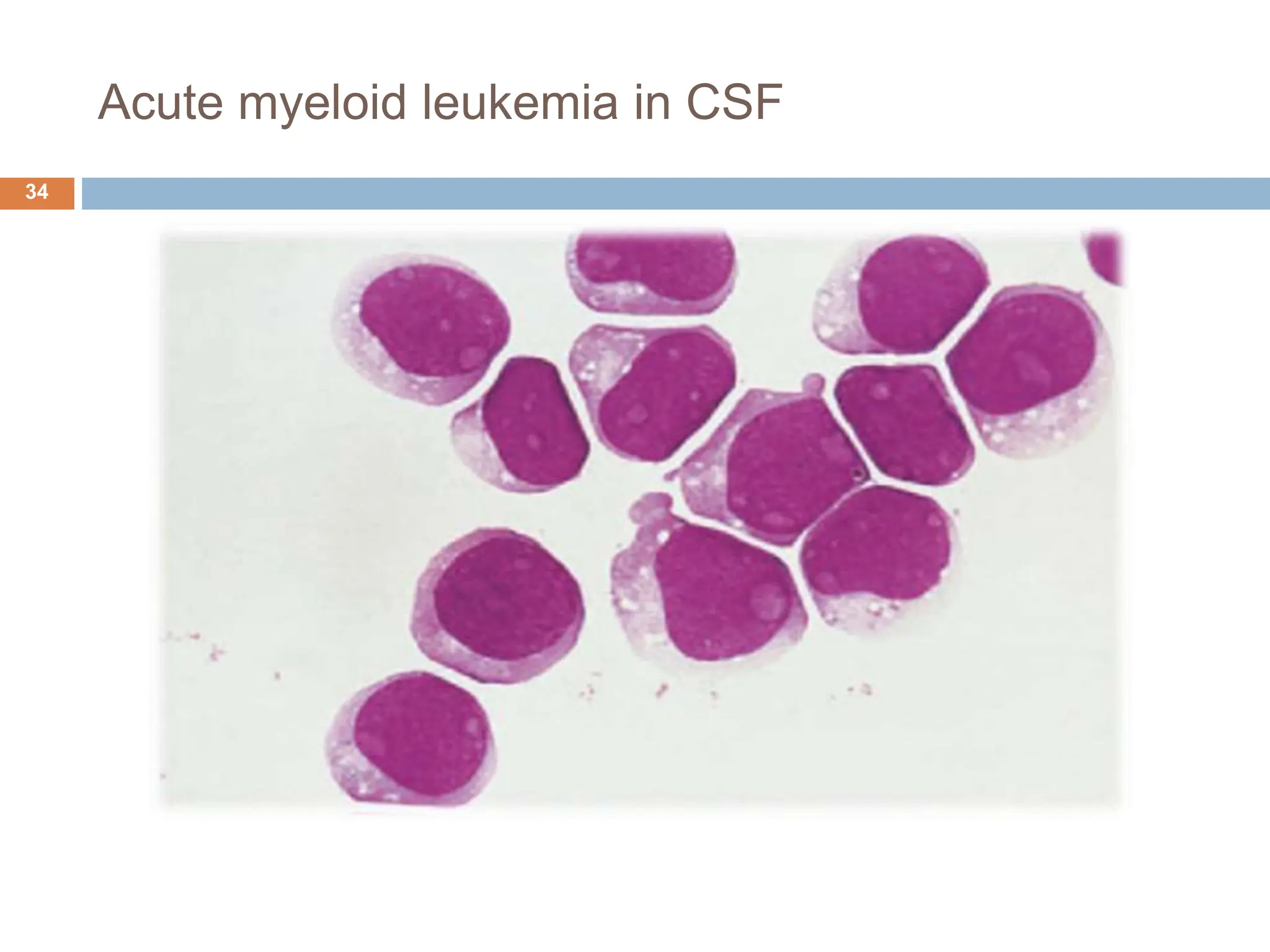 Acute myeloid leukemia in CSF
34
 