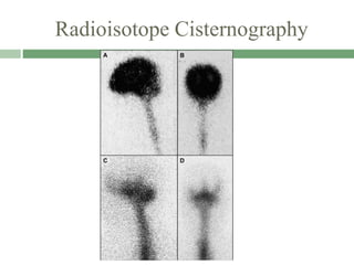 Radioisotope Cisternography
 