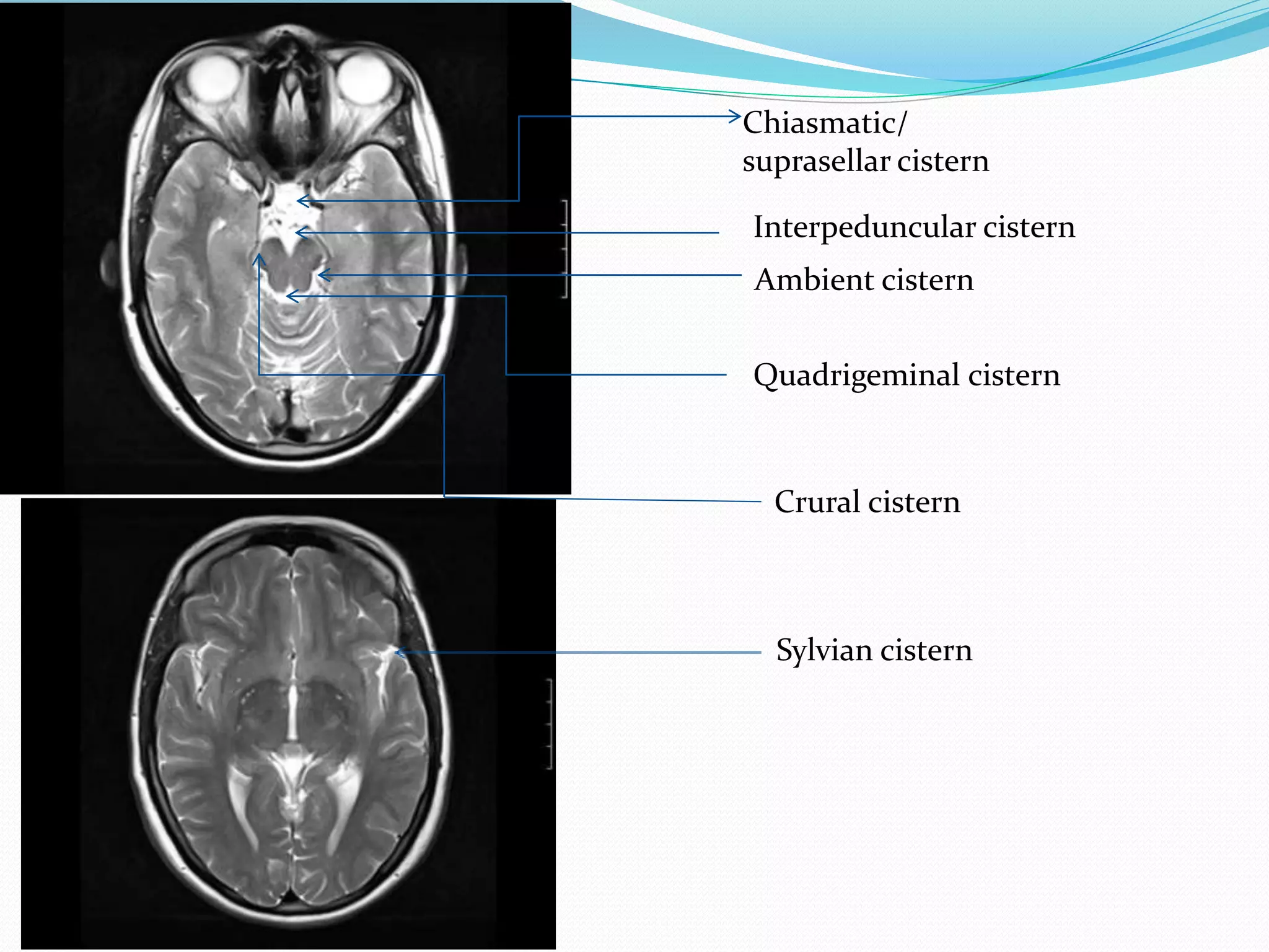 Interpeduncular cistern
Ambient cistern
Quadrigeminal cistern
Sylvian cistern
Chiasmatic/
suprasellar cistern
Crural cistern
 