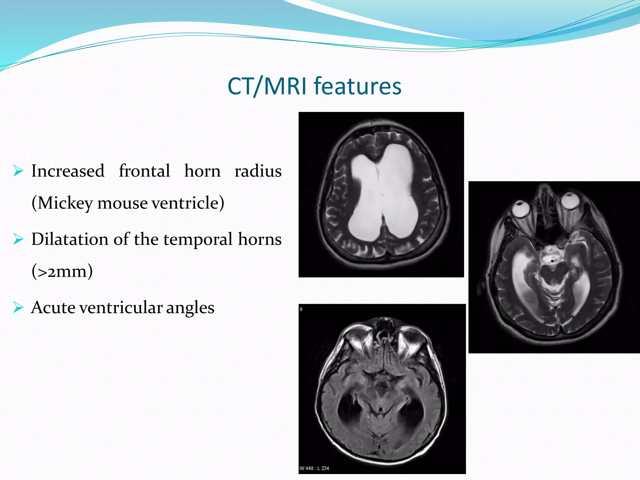 CT/MRI features
 Increased frontal horn radius
(Mickey mouse ventricle)
 Dilatation of the temporal horns
(>2mm)
 Acute ventricular angles
 
