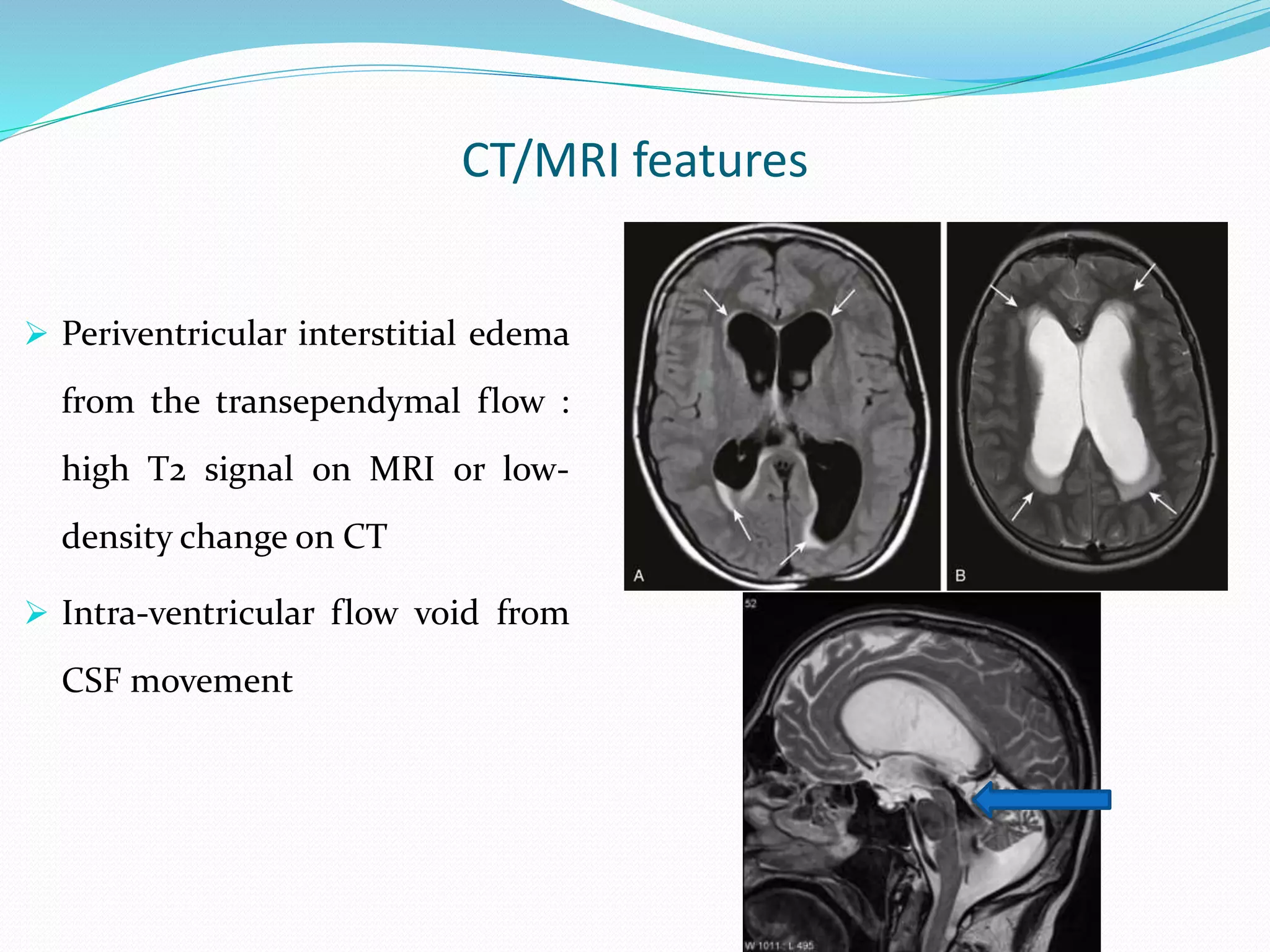 CT/MRI features
 Periventricular interstitial edema
from the transependymal flow :
high T2 signal on MRI or low-
density change on CT
 Intra-ventricular flow void from
CSF movement
 