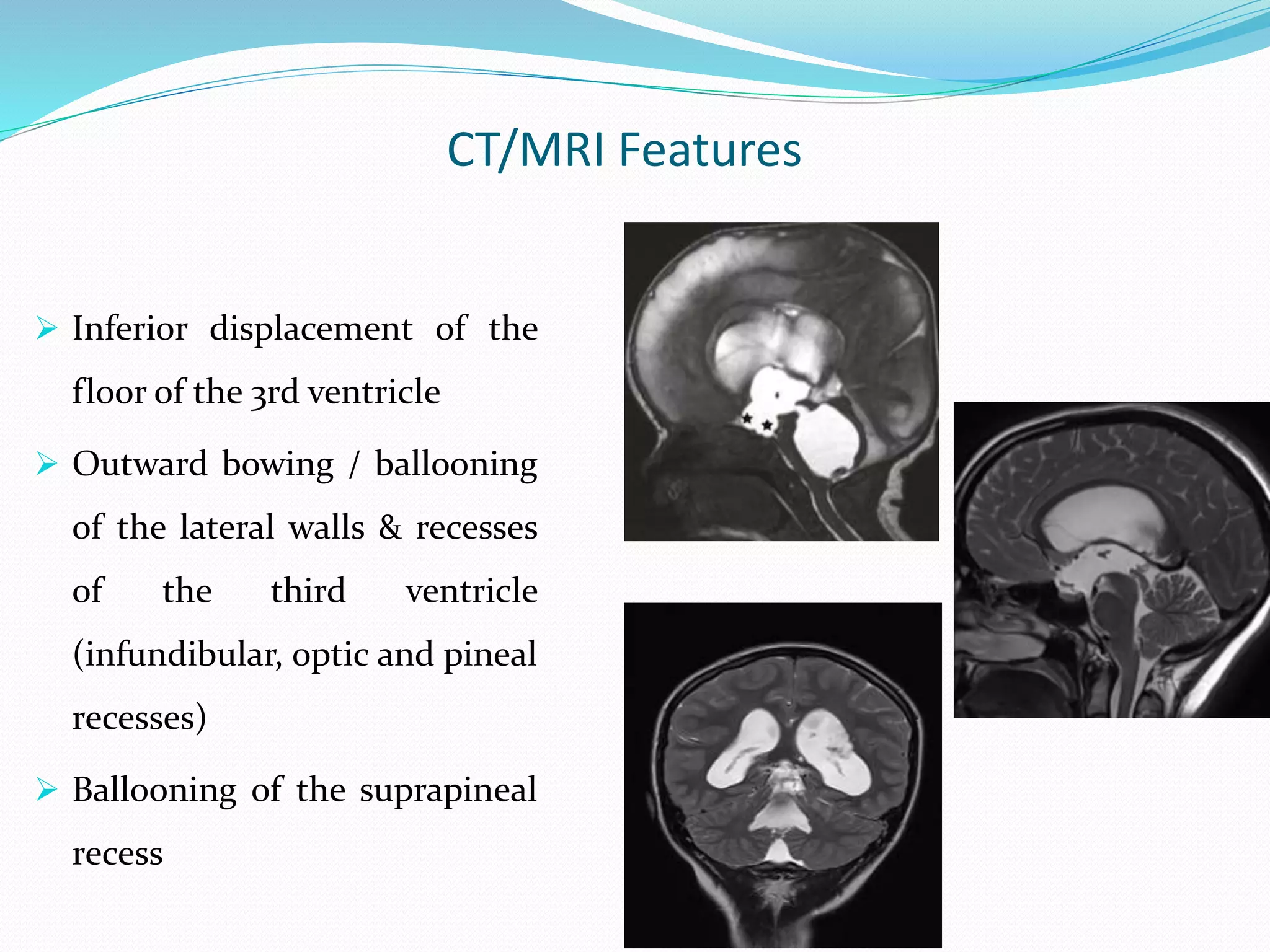 CT/MRI Features
 Inferior displacement of the
floor of the 3rd ventricle
 Outward bowing / ballooning
of the lateral walls & recesses
of the third ventricle
(infundibular, optic and pineal
recesses)
 Ballooning of the suprapineal
recess
 