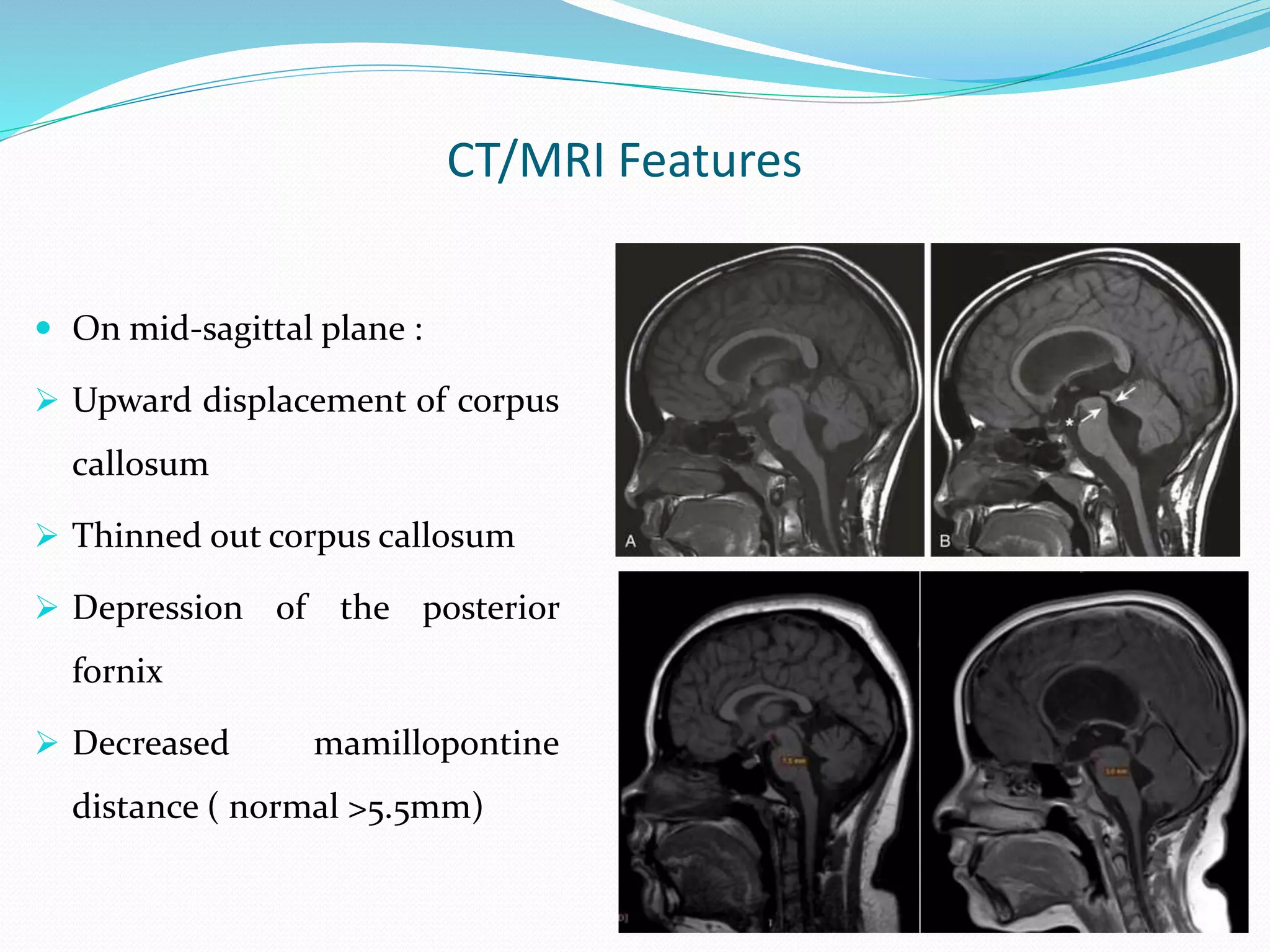 CT/MRI Features
 On mid-sagittal plane :
 Upward displacement of corpus
callosum
 Thinned out corpus callosum
 Depression of the posterior
fornix
 Decreased mamillopontine
distance ( normal >5.5mm)
 