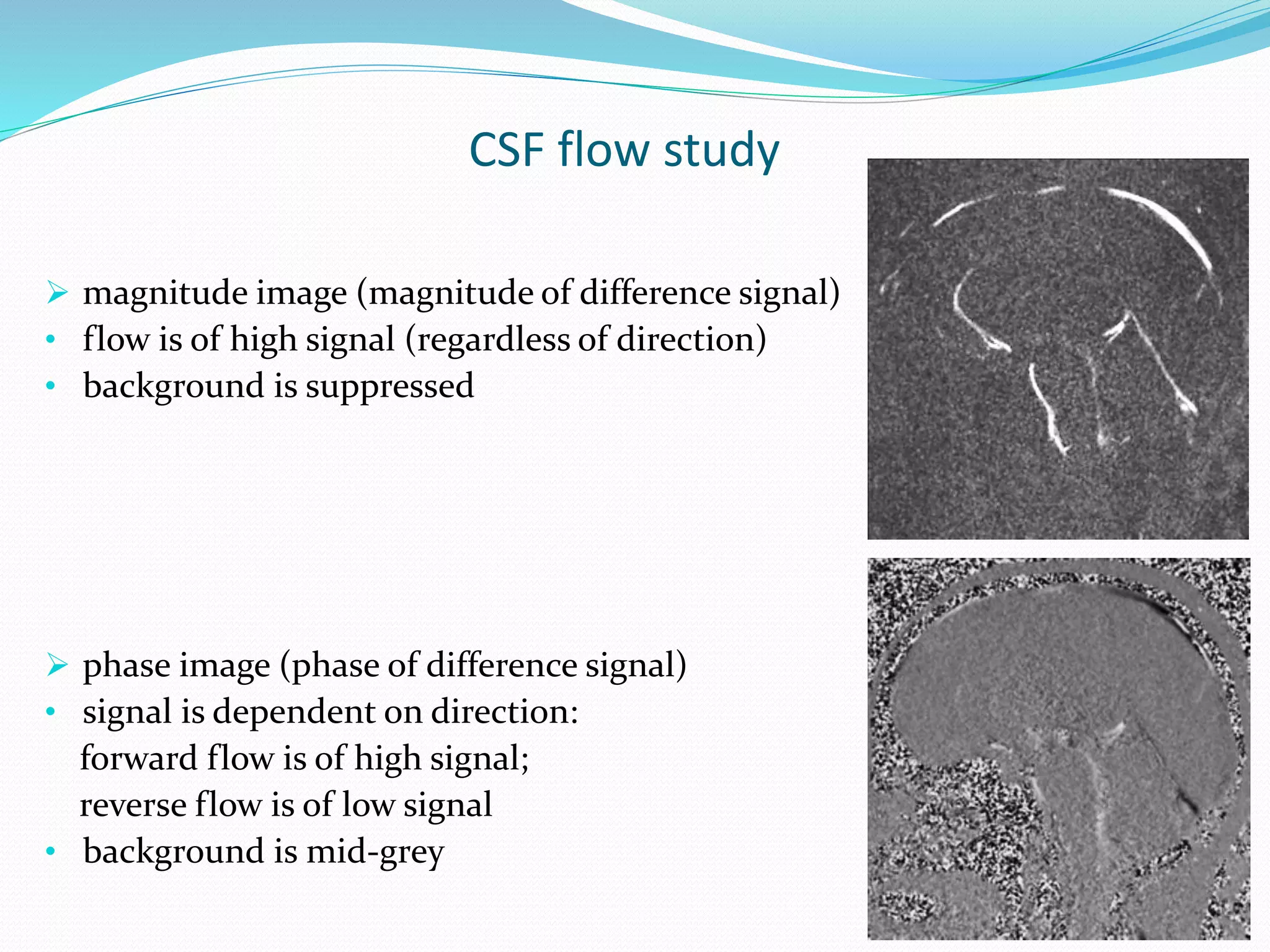 CSF flow study
 magnitude image (magnitude of difference signal)
• flow is of high signal (regardless of direction)
• background is suppressed
 phase image (phase of difference signal)
• signal is dependent on direction:
forward flow is of high signal;
reverse flow is of low signal
• background is mid-grey
 