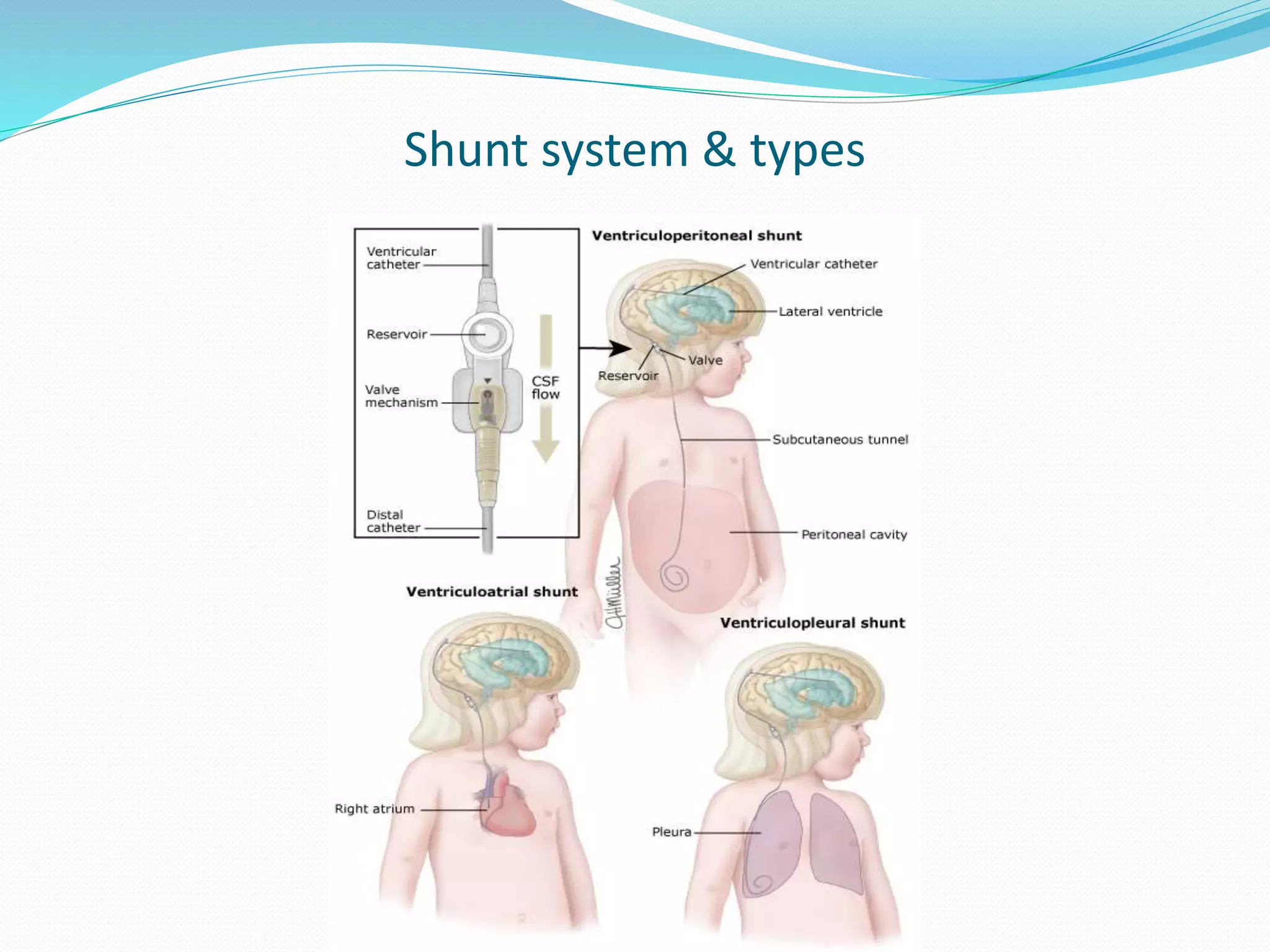 Shunt system & types
 