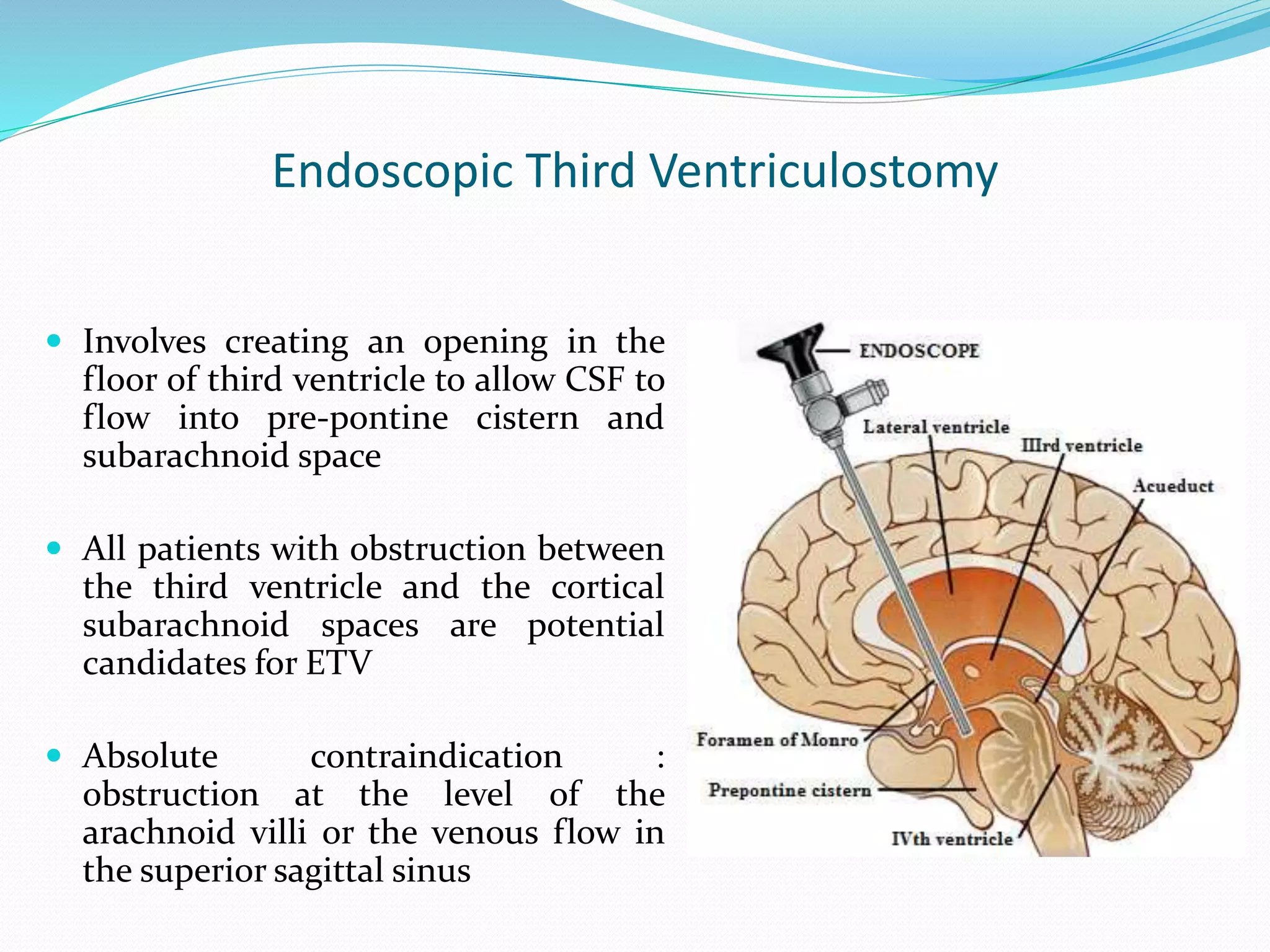 Endoscopic Third Ventriculostomy
 Involves creating an opening in the
floor of third ventricle to allow CSF to
flow into pre-pontine cistern and
subarachnoid space
 All patients with obstruction between
the third ventricle and the cortical
subarachnoid spaces are potential
candidates for ETV
 Absolute contraindication :
obstruction at the level of the
arachnoid villi or the venous flow in
the superior sagittal sinus
 