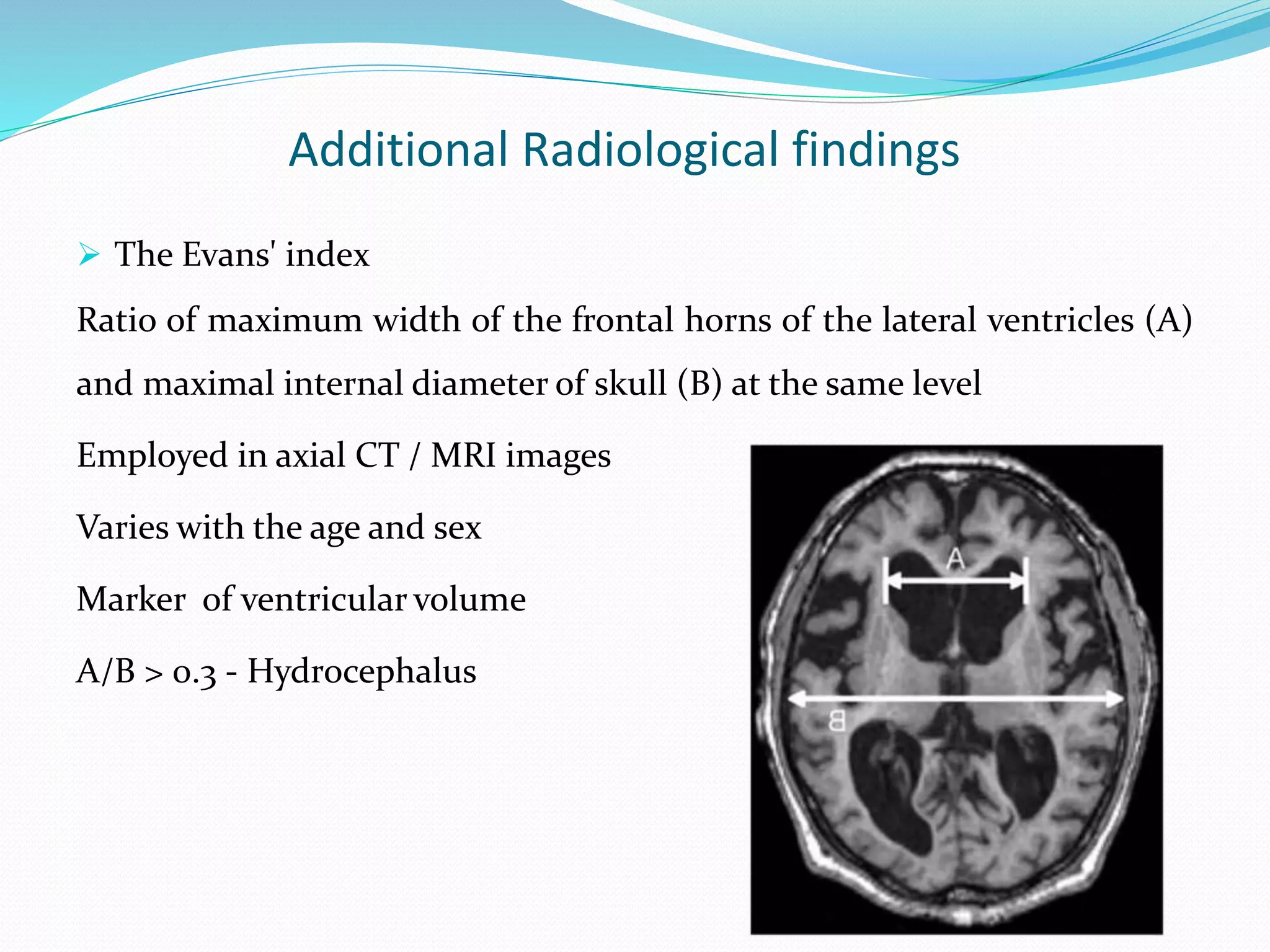 Additional Radiological findings
 The Evans' index
Ratio of maximum width of the frontal horns of the lateral ventricles (A)
and maximal internal diameter of skull (B) at the same level
Employed in axial CT / MRI images
Varies with the age and sex
Marker of ventricular volume
A/B > 0.3 - Hydrocephalus
 