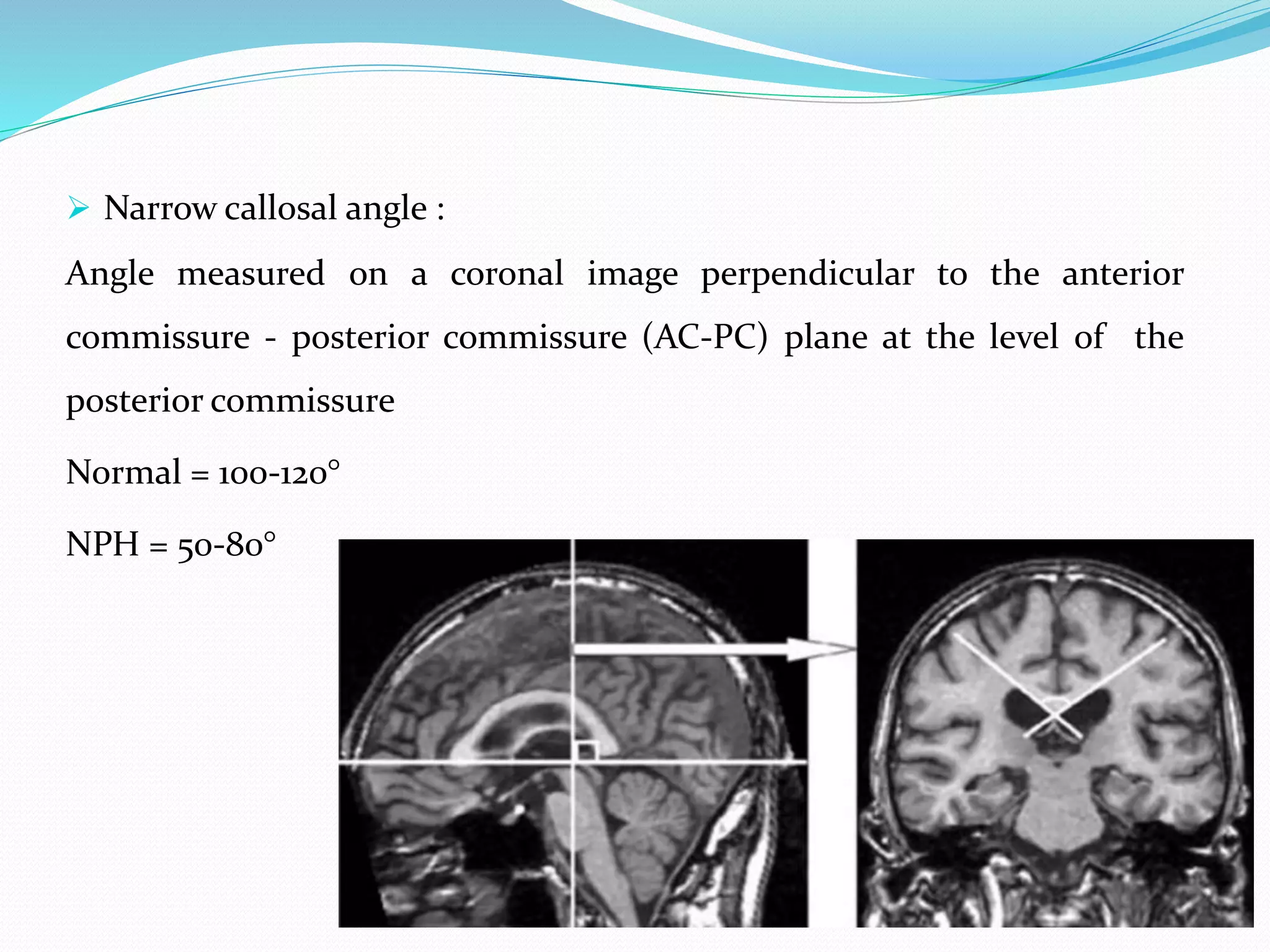  Narrow callosal angle :
Angle measured on a coronal image perpendicular to the anterior
commissure - posterior commissure (AC-PC) plane at the level of the
posterior commissure
Normal = 100-120°
NPH = 50-80°
 