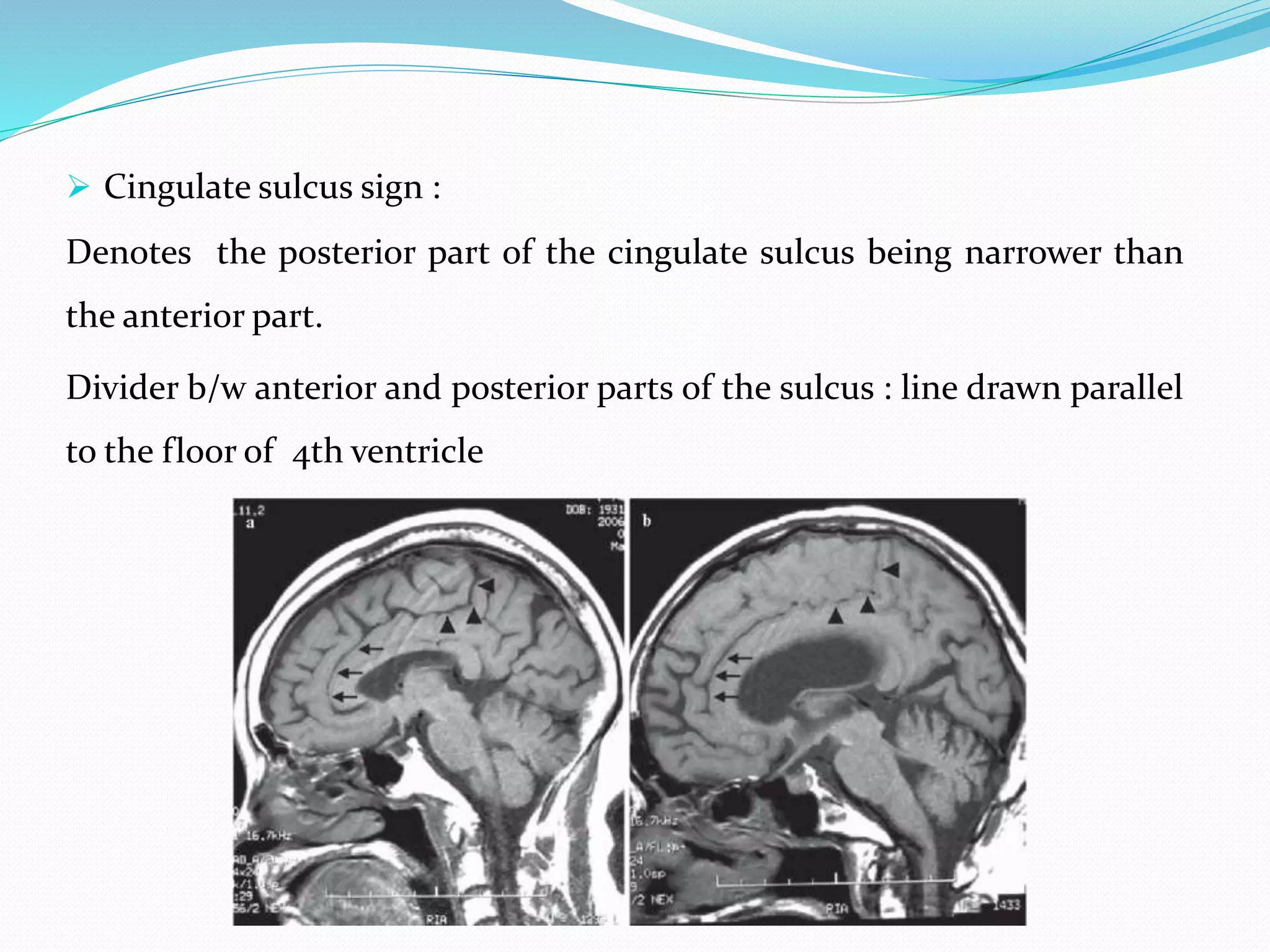  Cingulate sulcus sign :
Denotes the posterior part of the cingulate sulcus being narrower than
the anterior part.
Divider b/w anterior and posterior parts of the sulcus : line drawn parallel
to the floor of 4th ventricle
 