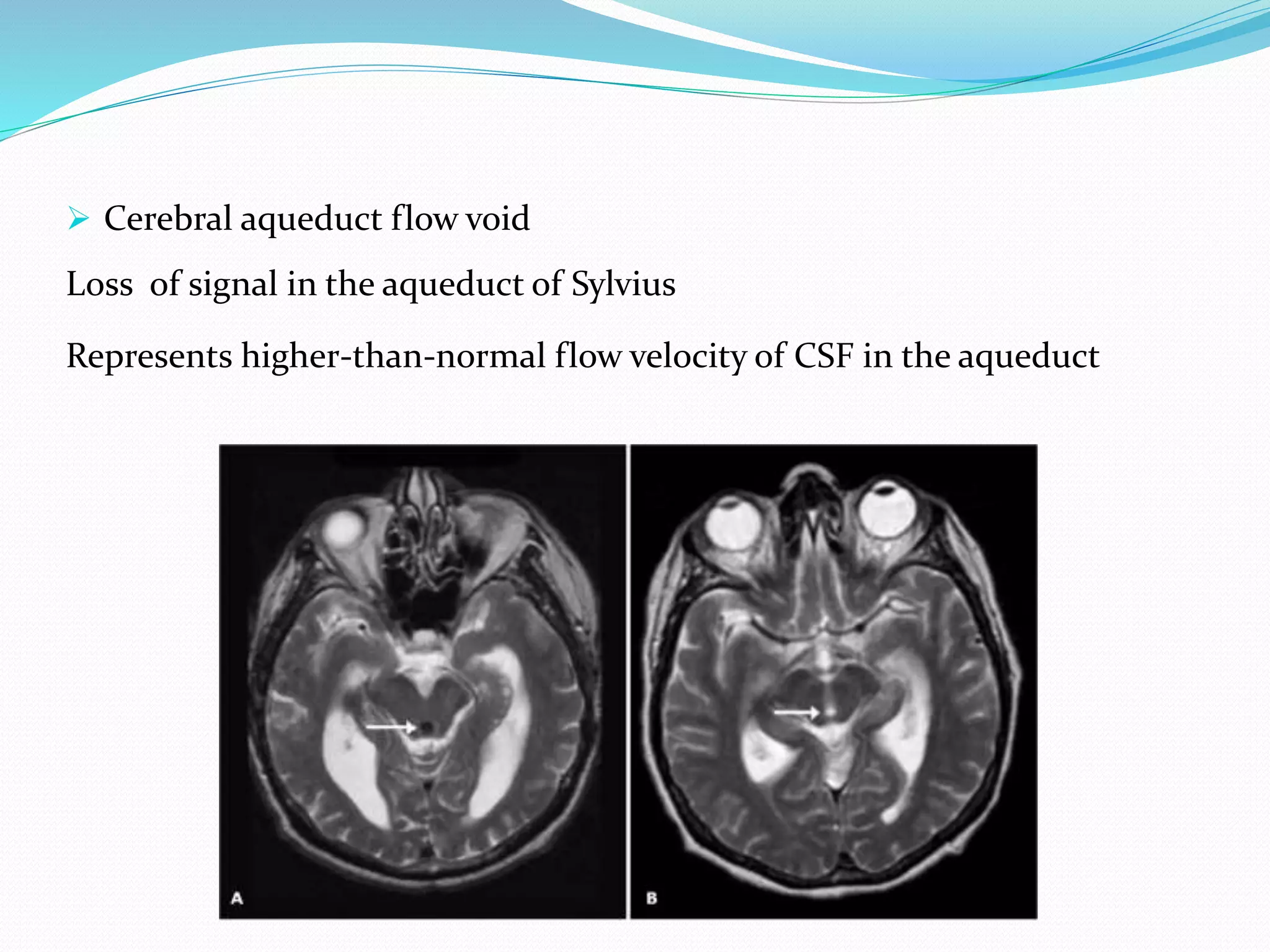  Cerebral aqueduct flow void
Loss of signal in the aqueduct of Sylvius
Represents higher-than-normal flow velocity of CSF in the aqueduct
 