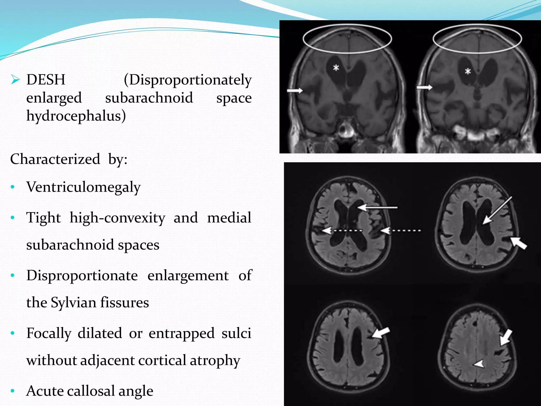  DESH (Disproportionately
enlarged subarachnoid space
hydrocephalus)
Characterized by:
• Ventriculomegaly
• Tight high-convexity and medial
subarachnoid spaces
• Disproportionate enlargement of
the Sylvian fissures
• Focally dilated or entrapped sulci
without adjacent cortical atrophy
• Acute callosal angle
 