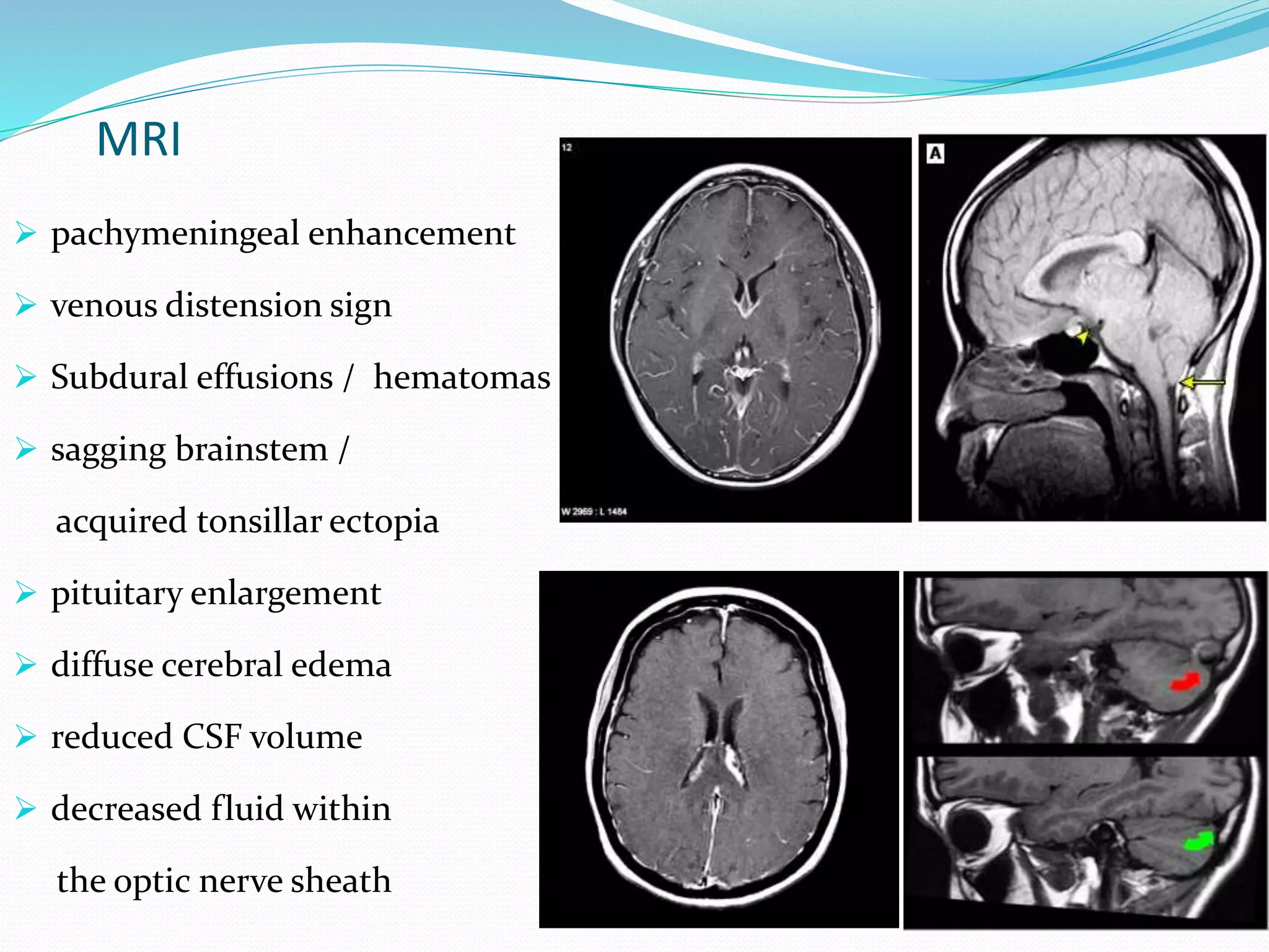 MRI
 pachymeningeal enhancement
 venous distension sign
 Subdural effusions / hematomas
 sagging brainstem /
acquired tonsillar ectopia
 pituitary enlargement
 diffuse cerebral edema
 reduced CSF volume
 decreased fluid within
the optic nerve sheath
 
