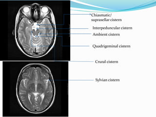 Interpeduncular cistern
Ambient cistern
Quadrigeminal cistern
Sylvian cistern
Chiasmatic/
suprasellar cistern
Crural cistern
 