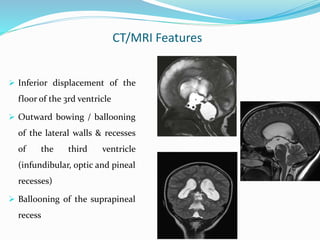 CT/MRI Features
 Inferior displacement of the
floor of the 3rd ventricle
 Outward bowing / ballooning
of the lateral walls & recesses
of the third ventricle
(infundibular, optic and pineal
recesses)
 Ballooning of the suprapineal
recess
 