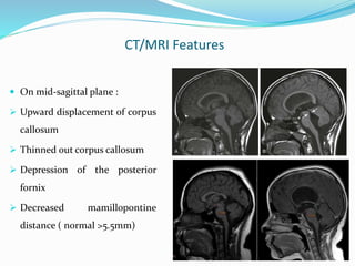 CT/MRI Features
 On mid-sagittal plane :
 Upward displacement of corpus
callosum
 Thinned out corpus callosum
 Depression of the posterior
fornix
 Decreased mamillopontine
distance ( normal >5.5mm)
 