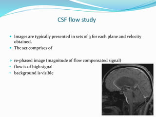 CSF flow study
 Images are typically presented in sets of 3 for each plane and velocity
obtained.
 The set comprises of
 re-phased image (magnitude of flow compensated signal)
• flow is of high signal
• background is visible
 