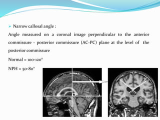  Narrow callosal angle :
Angle measured on a coronal image perpendicular to the anterior
commissure - posterior commissure (AC-PC) plane at the level of the
posterior commissure
Normal = 100-120°
NPH = 50-80°
 