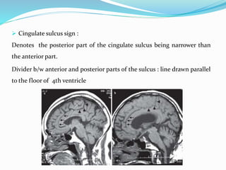  Cingulate sulcus sign :
Denotes the posterior part of the cingulate sulcus being narrower than
the anterior part.
Divider b/w anterior and posterior parts of the sulcus : line drawn parallel
to the floor of 4th ventricle
 
