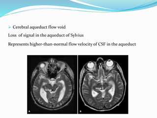  Cerebral aqueduct flow void
Loss of signal in the aqueduct of Sylvius
Represents higher-than-normal flow velocity of CSF in the aqueduct
 