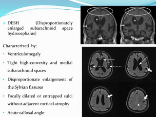  DESH (Disproportionately
enlarged subarachnoid space
hydrocephalus)
Characterized by:
• Ventriculomegaly
• Tight high-convexity and medial
subarachnoid spaces
• Disproportionate enlargement of
the Sylvian fissures
• Focally dilated or entrapped sulci
without adjacent cortical atrophy
• Acute callosal angle
 
