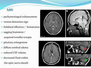 MRI
 pachymeningeal enhancement
 venous distension sign
 Subdural effusions / hematomas
 sagging brainstem /
acquired tonsillar ectopia
 pituitary enlargement
 diffuse cerebral edema
 reduced CSF volume
 decreased fluid within
the optic nerve sheath
 